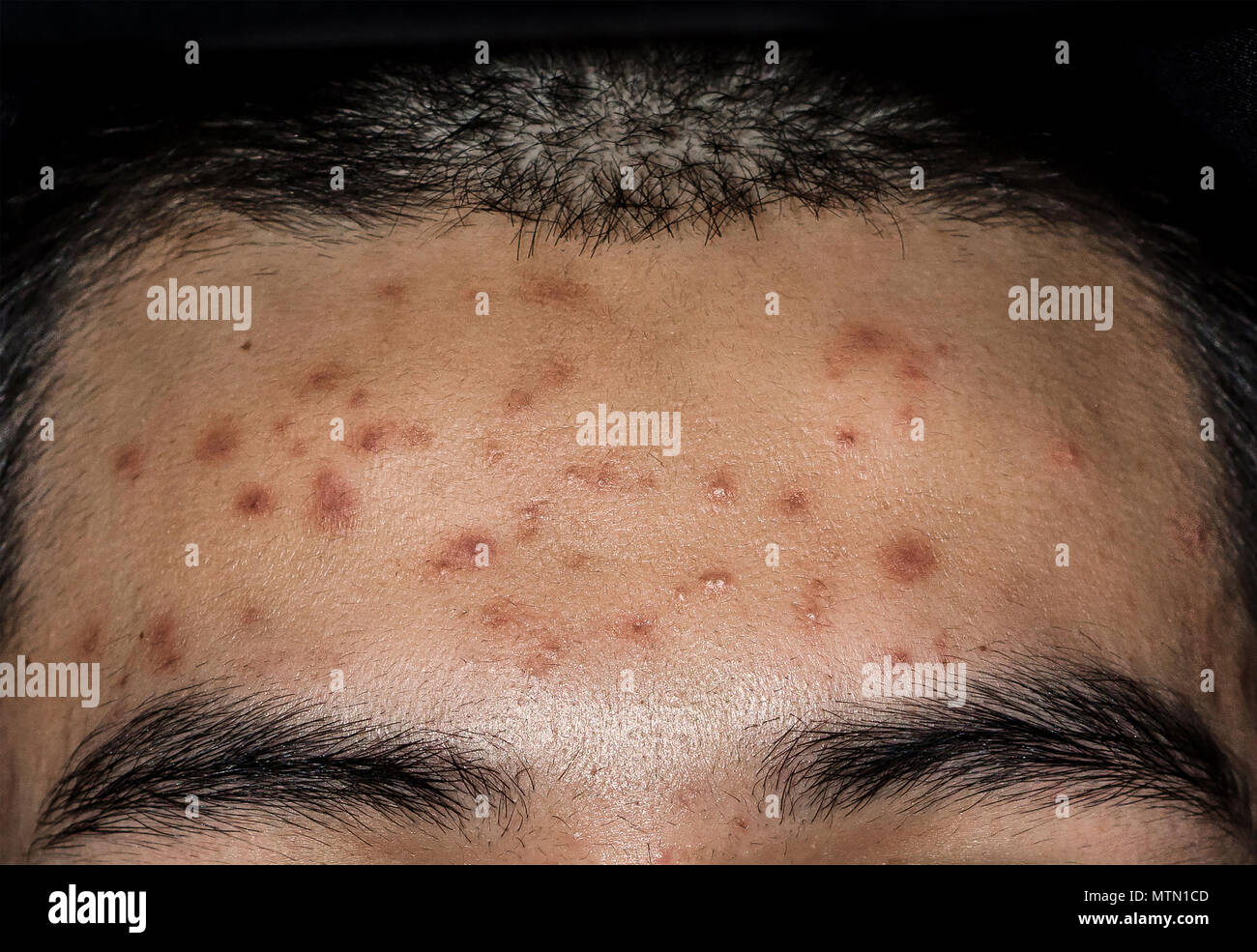 Close-up of acne on the skin, Acne on the face caused by Hormone, The scars, wrinkle and acne inflammation on the face skin Stock Photo