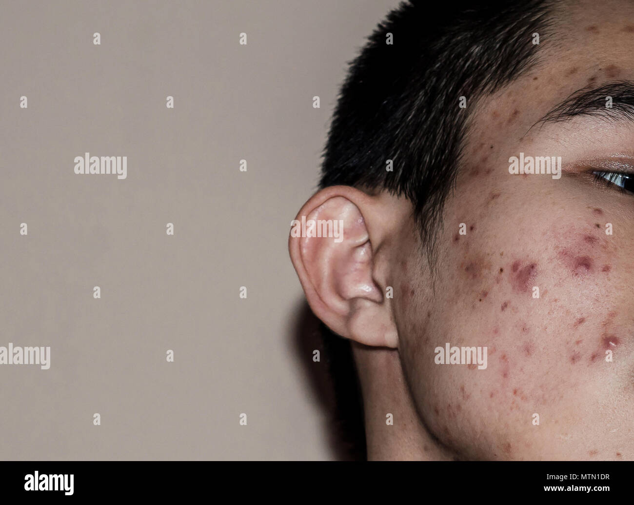 Close-up of acne on the skin, Acne on the face caused by Hormone, The scars, wrinkle and acne inflammation on the face skin Stock Photo