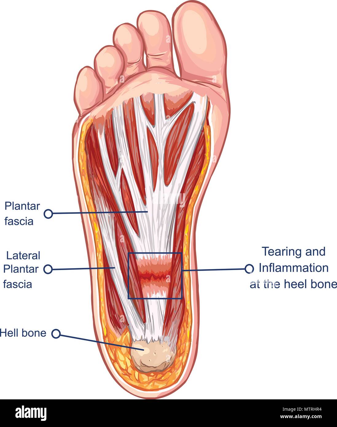 Vector  illustration of a Plantar Fasciitis Stock Vector