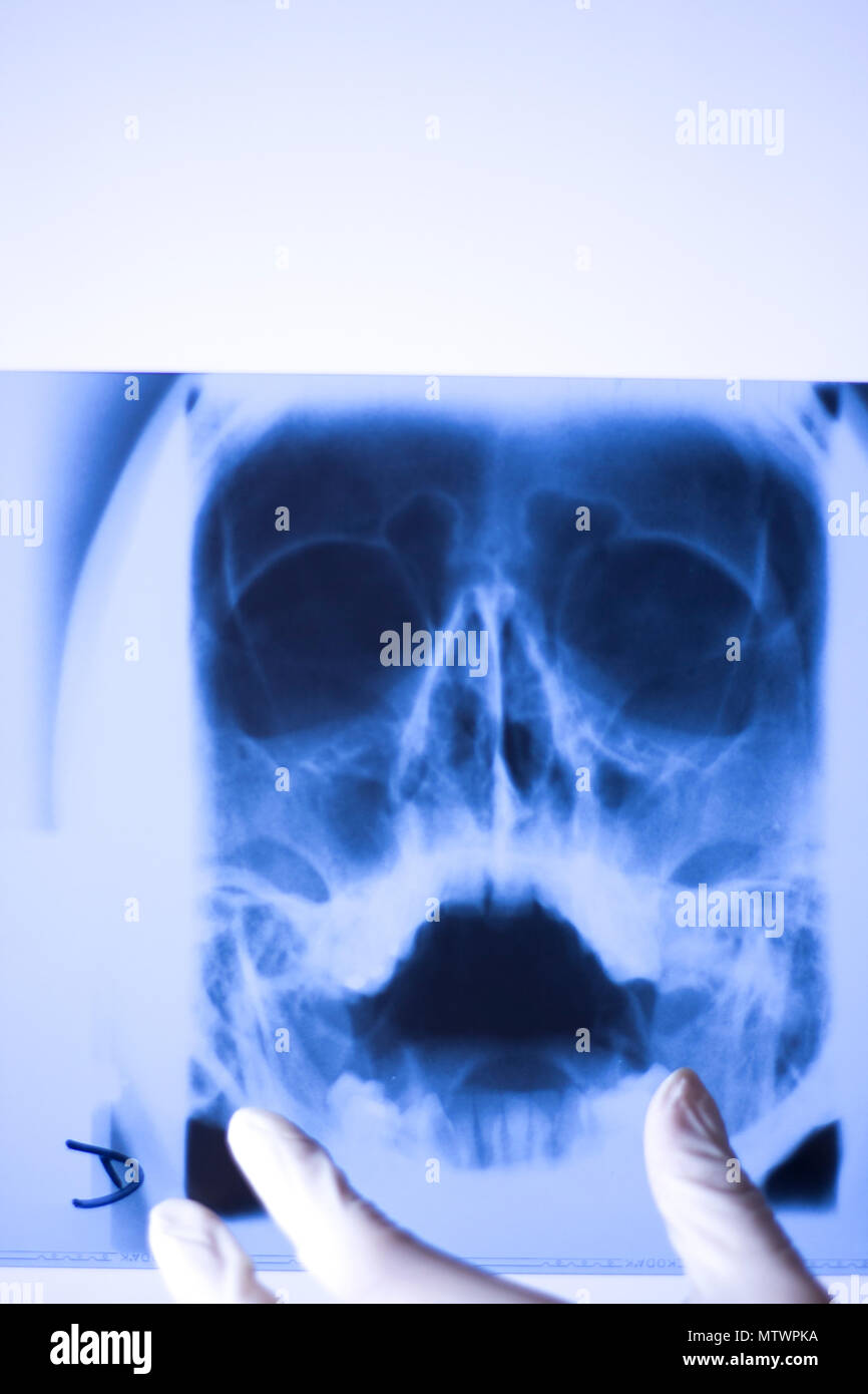 Download Medical Hospital X Ray Face Skull Mouth Teeth Nose And Eyes Scan Stock Photo Alamy PSD Mockup Templates