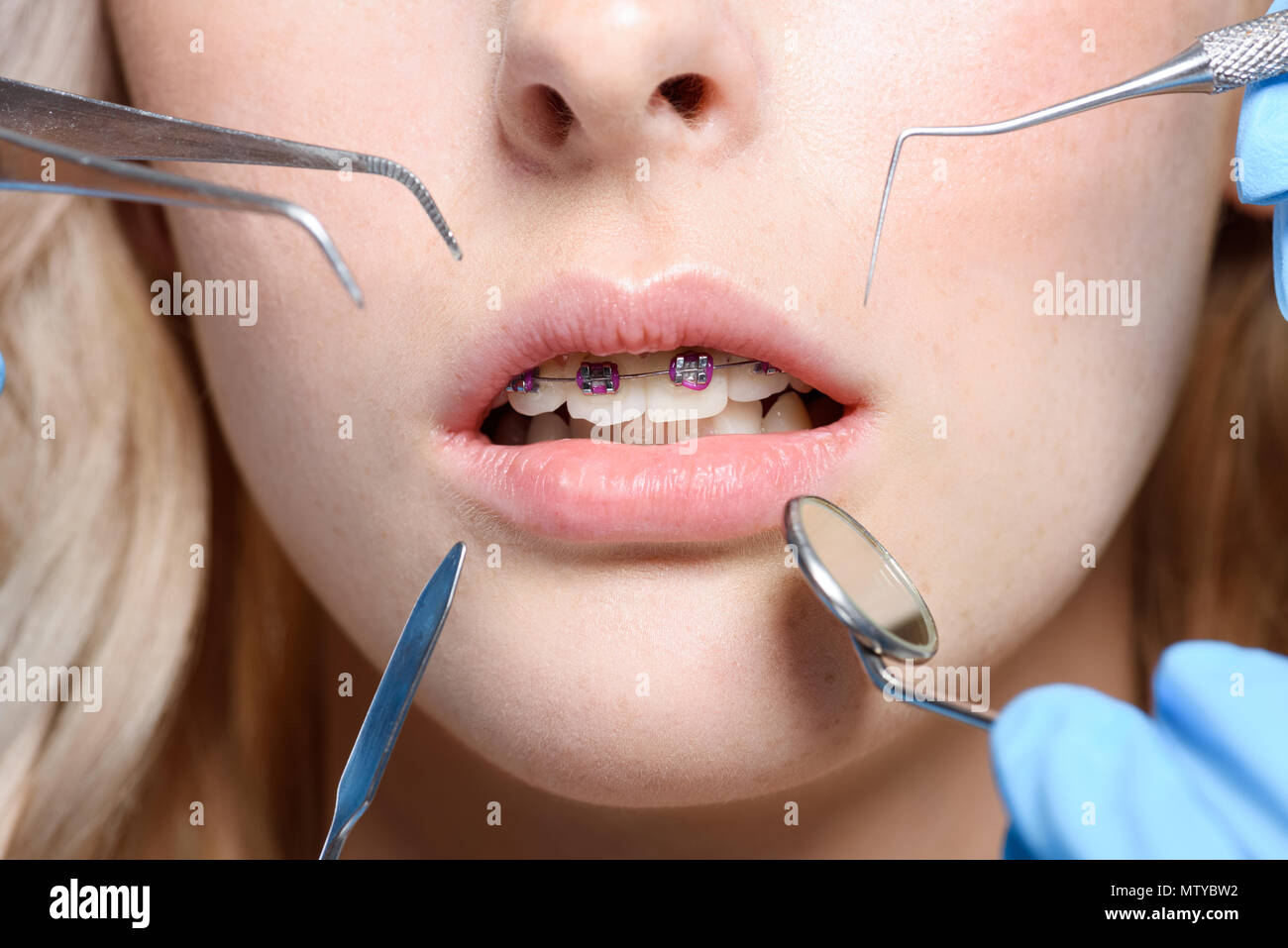 Closeup shot of dentist tools in front of female mouth with braces