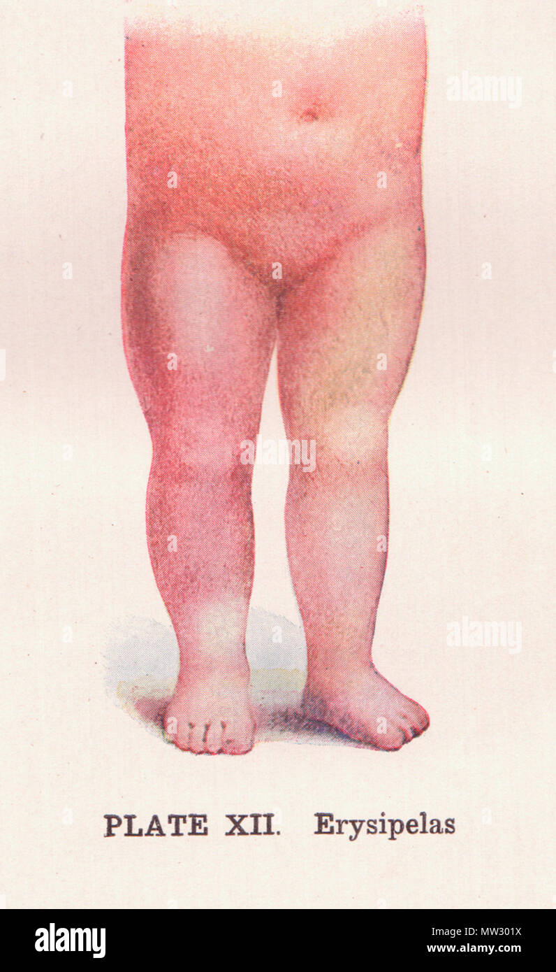 . English:   Between pages 280 and 281, this illustration of a child's legs is to show Erysipelas. Title The practical guide to health: a popular treatise on anatomy, physiology, and hygiene, with a scientific description of diseases, their causes and treatment : designed for nurses and for home use: Author Frederick Magee Rossiter Publisher Pacific Press Pub. Assn., 1913 Length 660 pages Flickr data on 2011-08-17: Tags: public domain, image, drawing, illustration, vintage, book, medical, The Practical Guide to Health License: CC BY 2.0 User: perpetualplum Sue Clark  . 1913  Flickr: 2009-08-06 Stock Photo