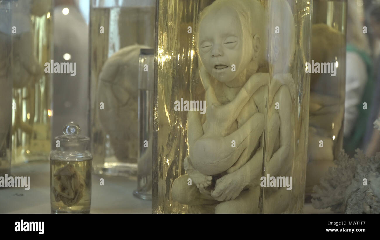Anatomical preserved human specimens, ugliness, anomalies. Human parts
