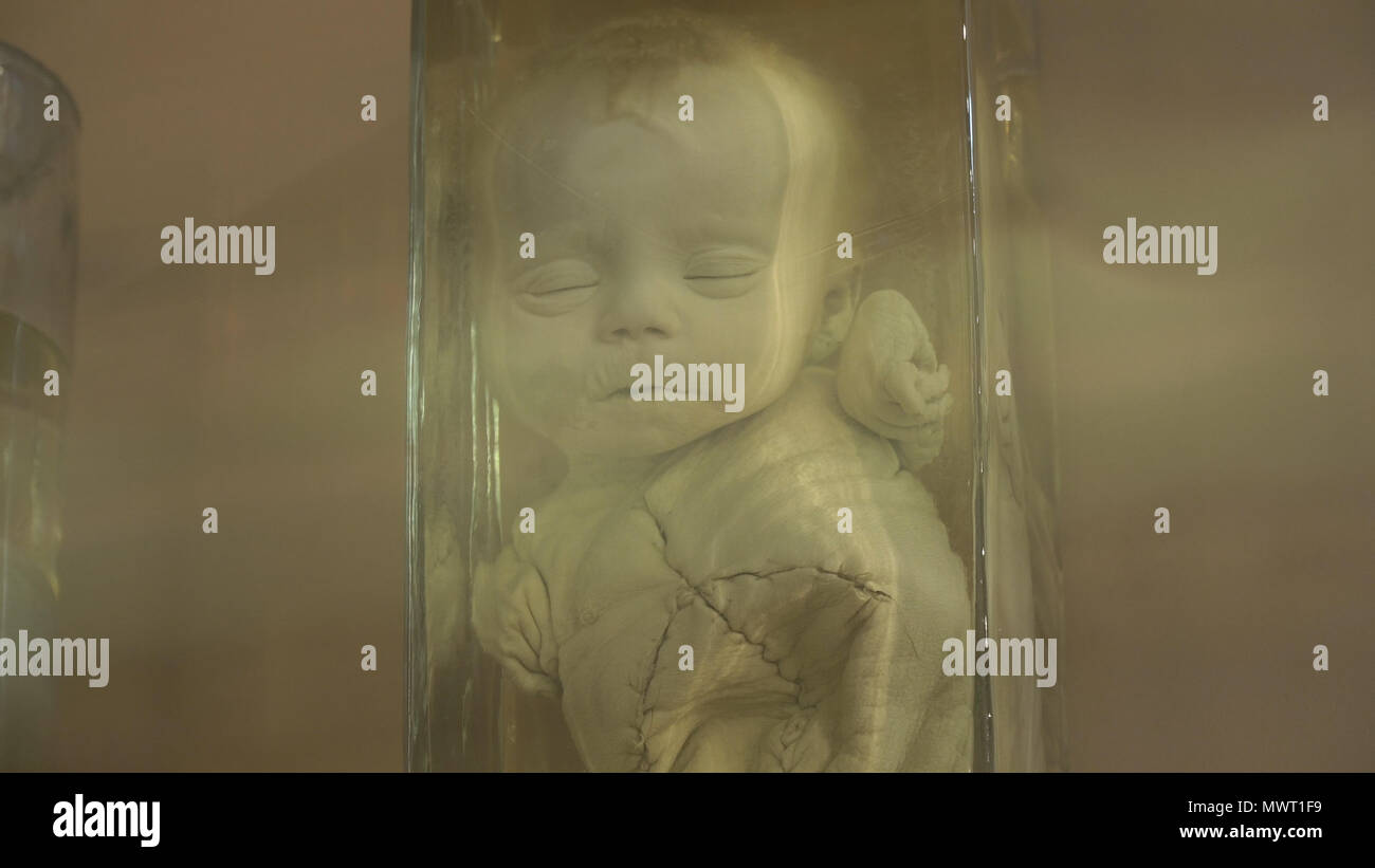 Anatomical preserved human specimens, ugliness, anomalies. Human parts of the body preserved in