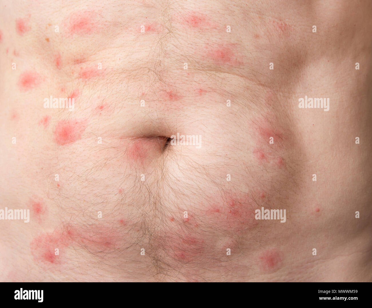 Man mosquito bites hi-res stock photography and images - Alamy