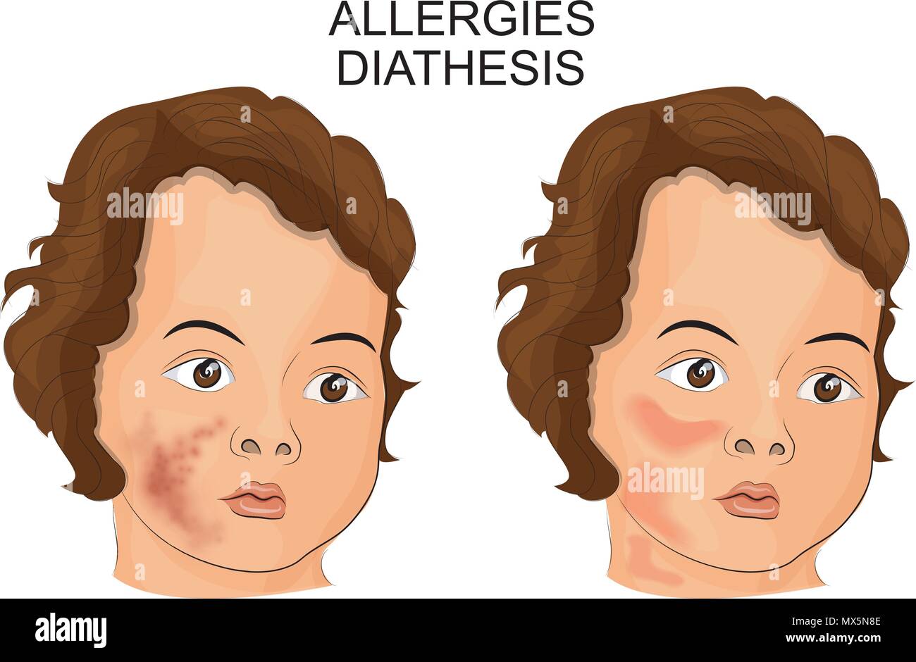 illustration of the face of a child suffering diathesis or Allergy Stock Vector