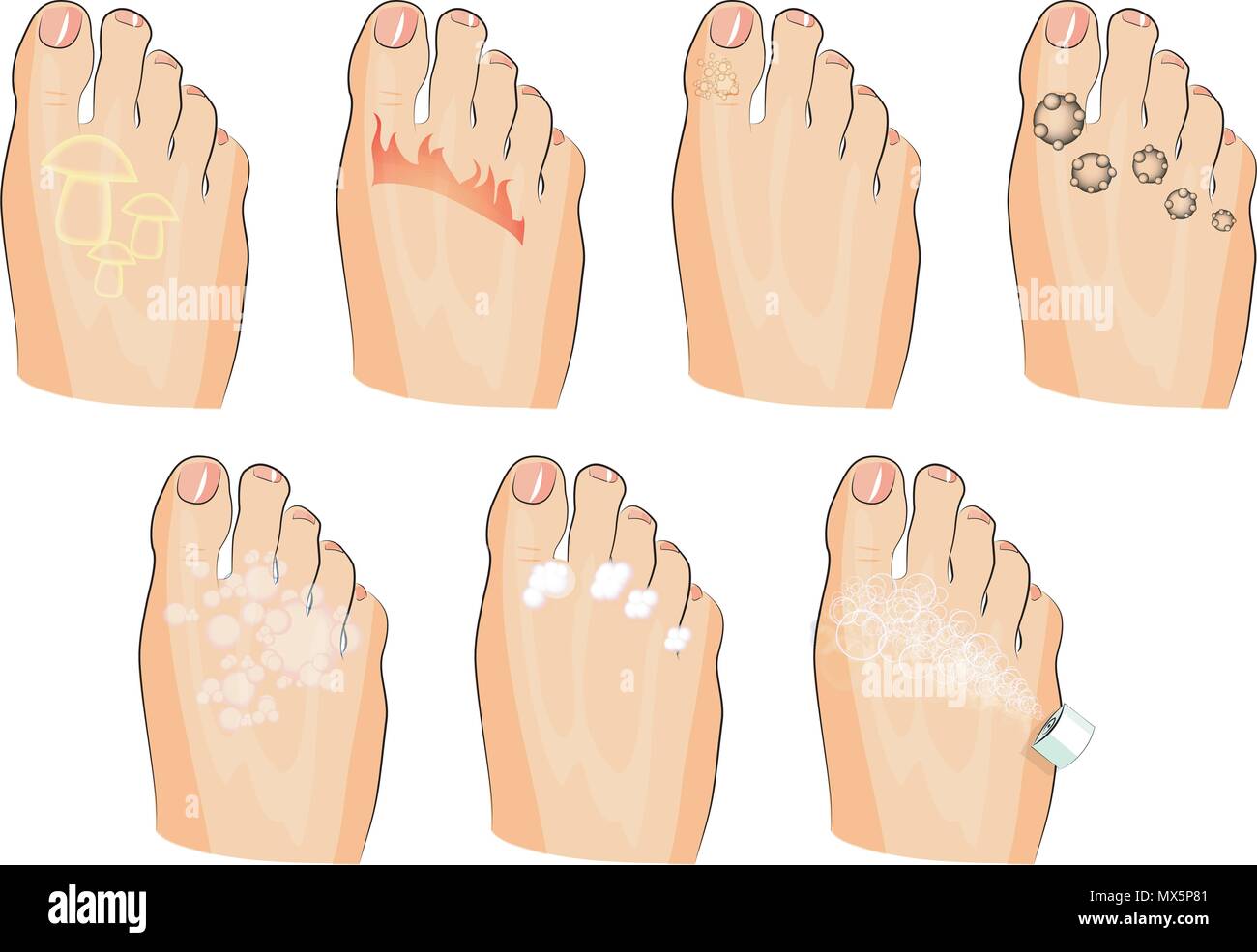illustration of the various injuries of the feet. fungus, burning, warts, sweating. as well as soap, lotion, and spray Stock Vector