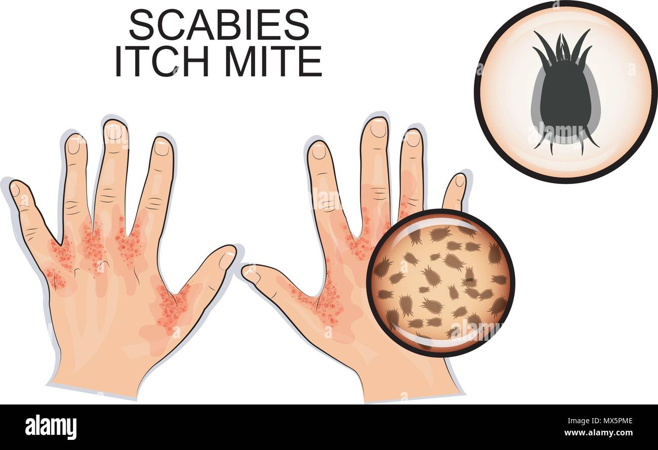 Can You Get Scabies From Touching Something