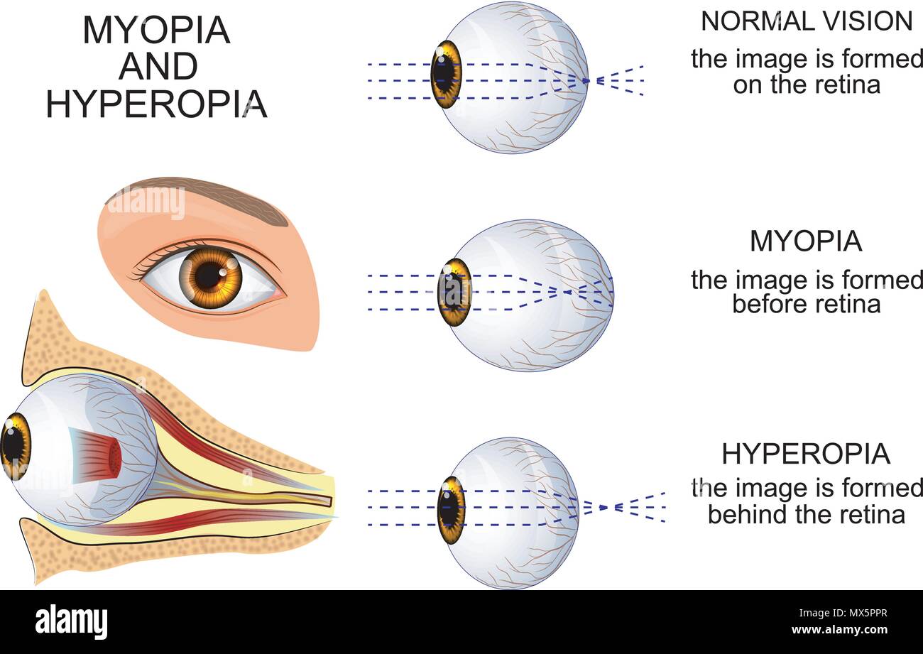illustration of a healthy eye, the eye, myopia and hyperopia Stock Vector