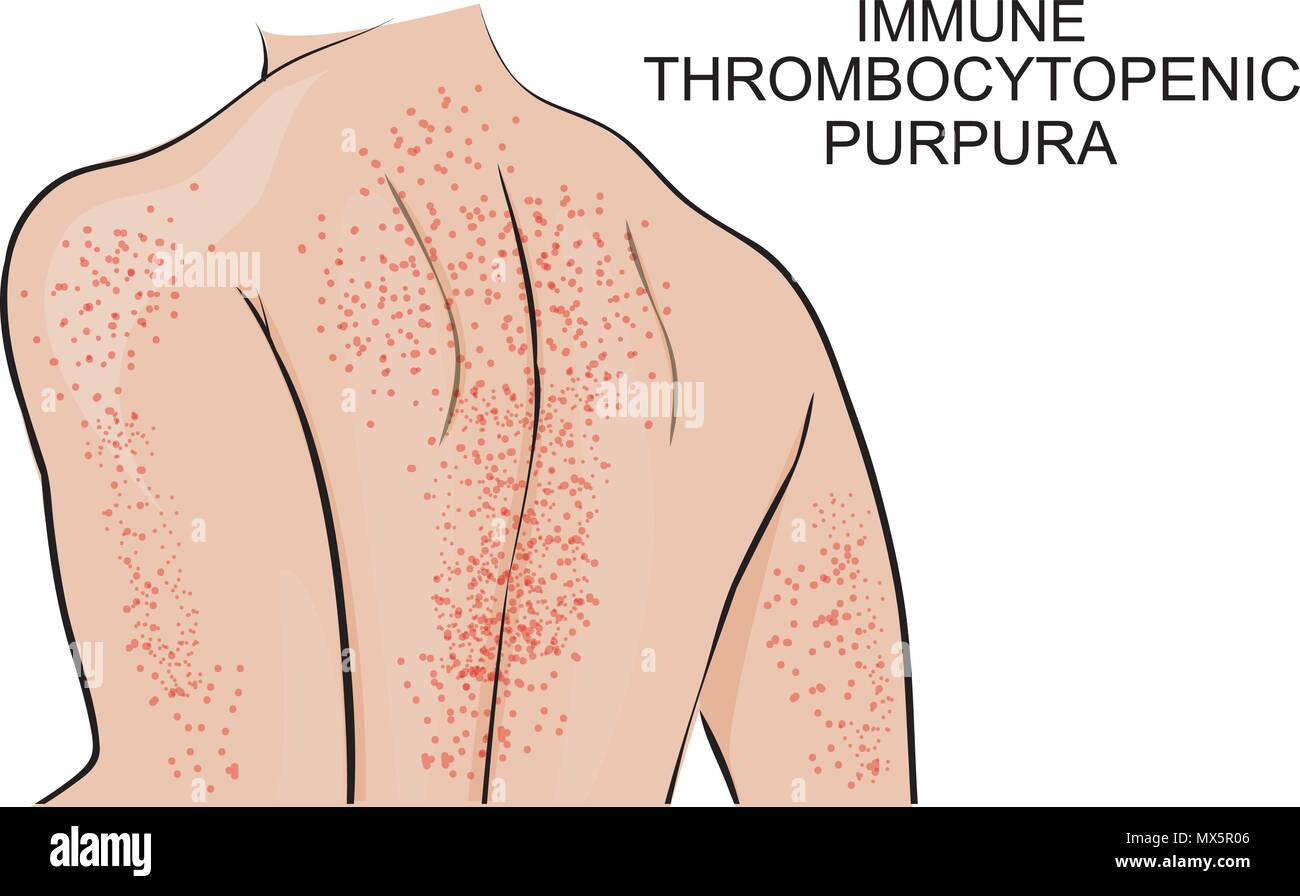 illustration of the back affected small rash from immune thrombocytopenic purpura disease Stock Vector