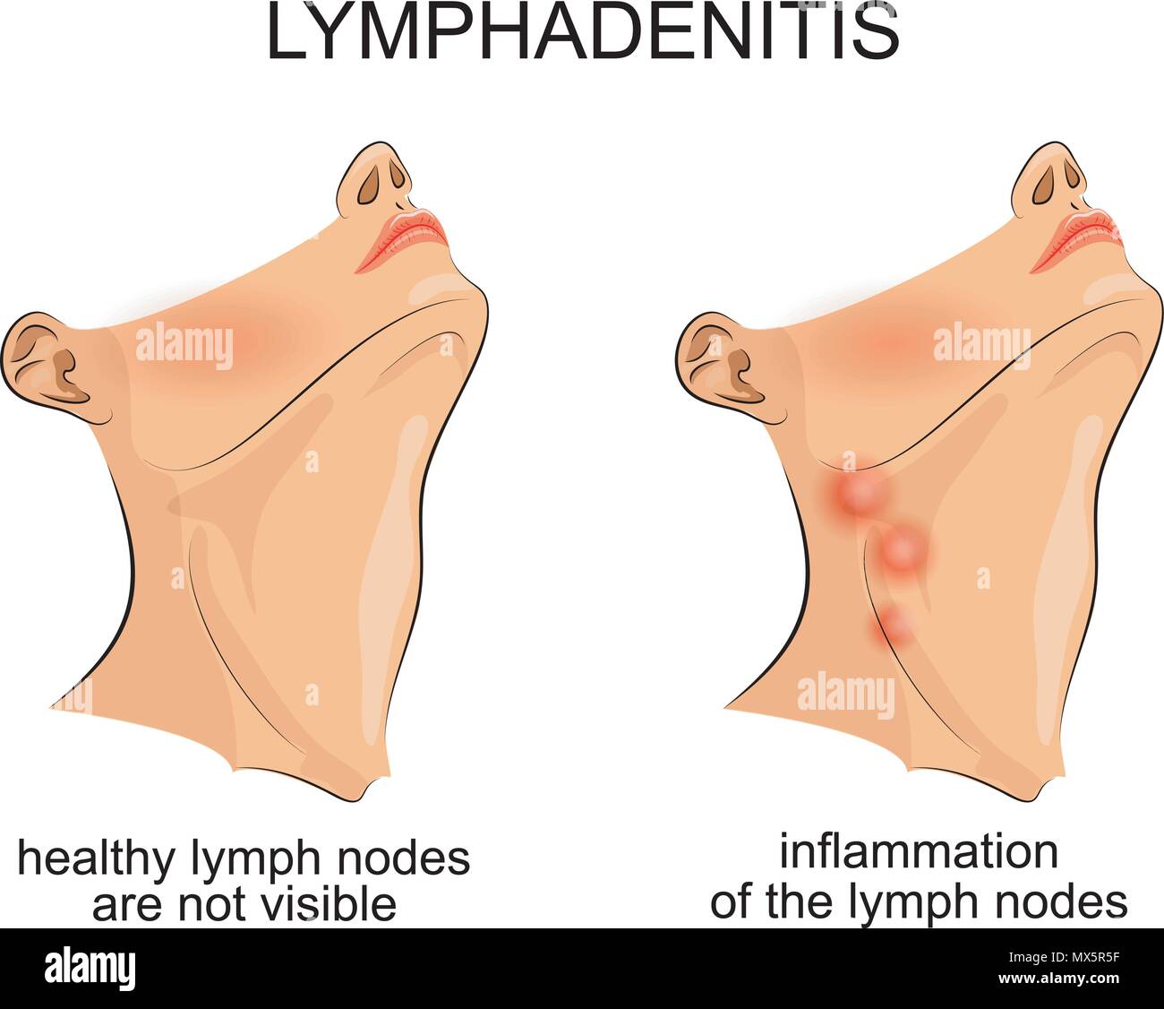 Submandibular Lymph Nodes