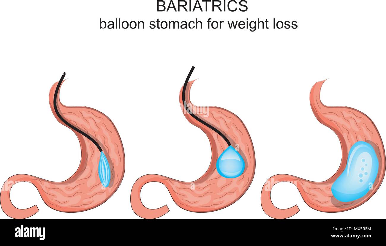 illustration of balloon stomach for weight loss Stock Vector Image