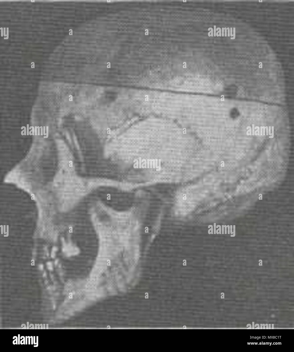 . English: Dinaric skull with especially marked Dinaric nose, and especially steep back to the head. 1927. Hans F.K. Gunther and the German Federal Archives 164 Dinaric Skull type Stock Photo