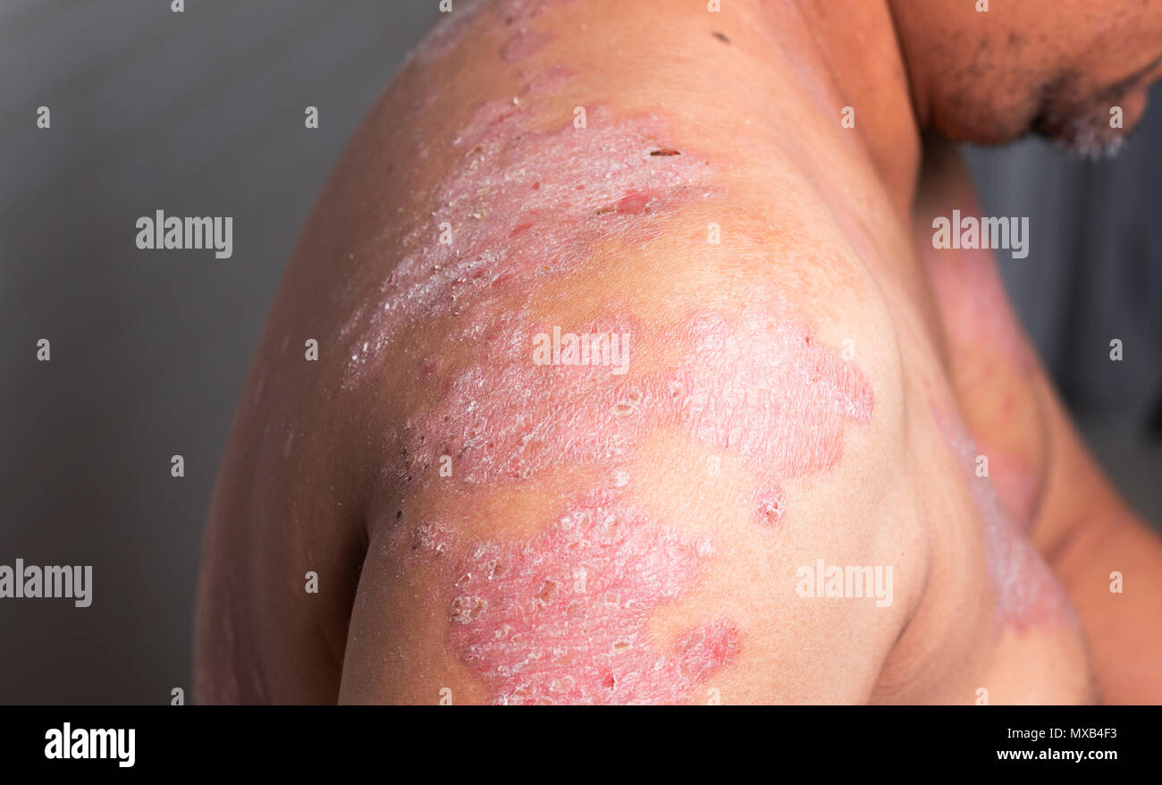 Diseases caused by abnormalities of the lymph and a skin disease. Stock Photo