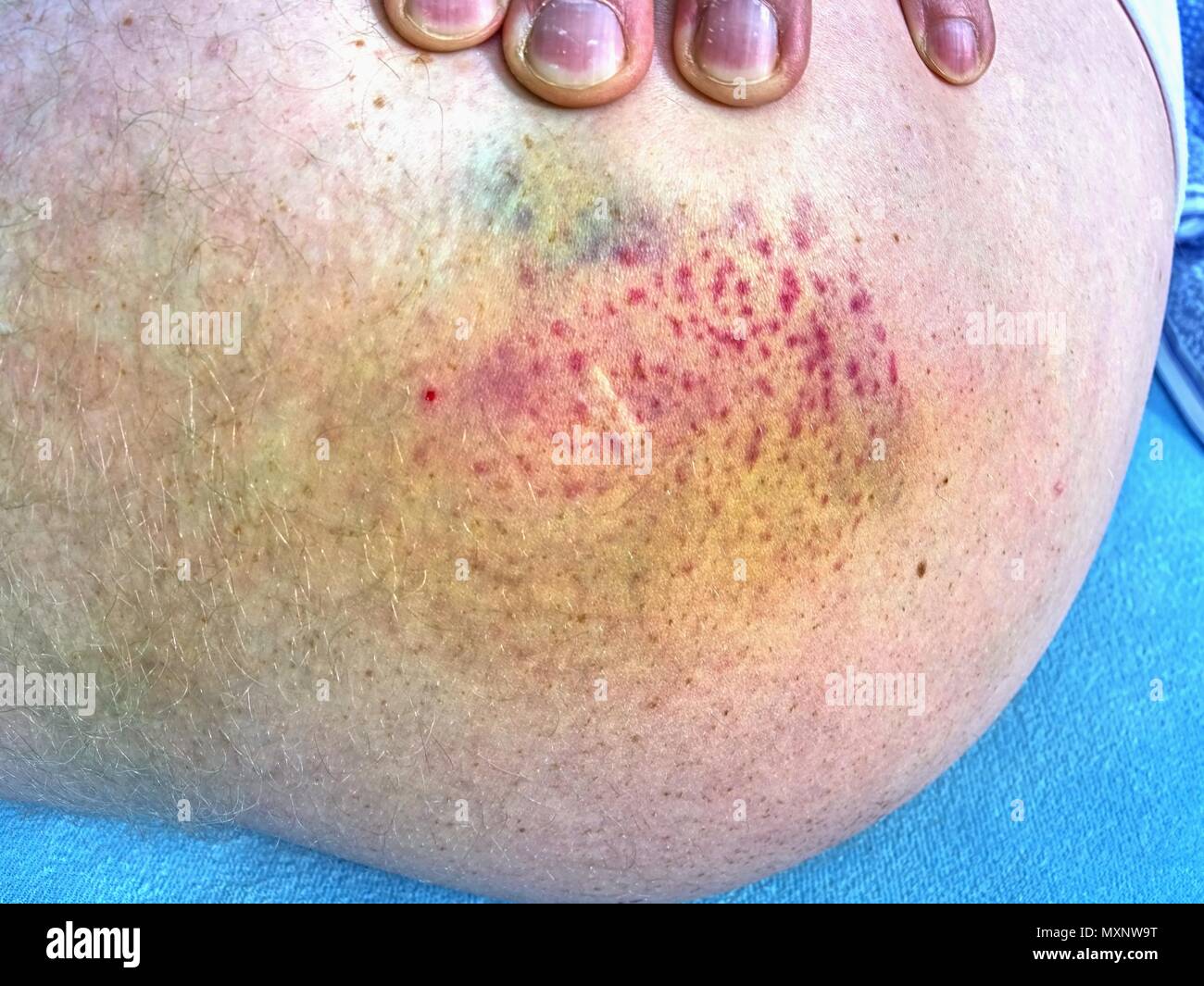 Bruised wound injury.  Patient show injured body with large paintful hematoma. Stock Photo