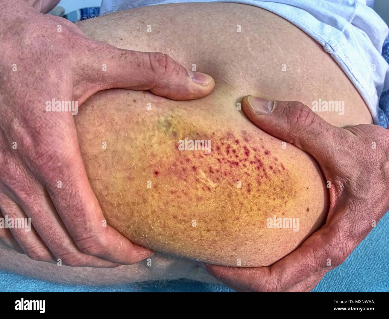 Bruised wound injury on human body. Patient show injured body with large paintful hematoma. Stock Photo