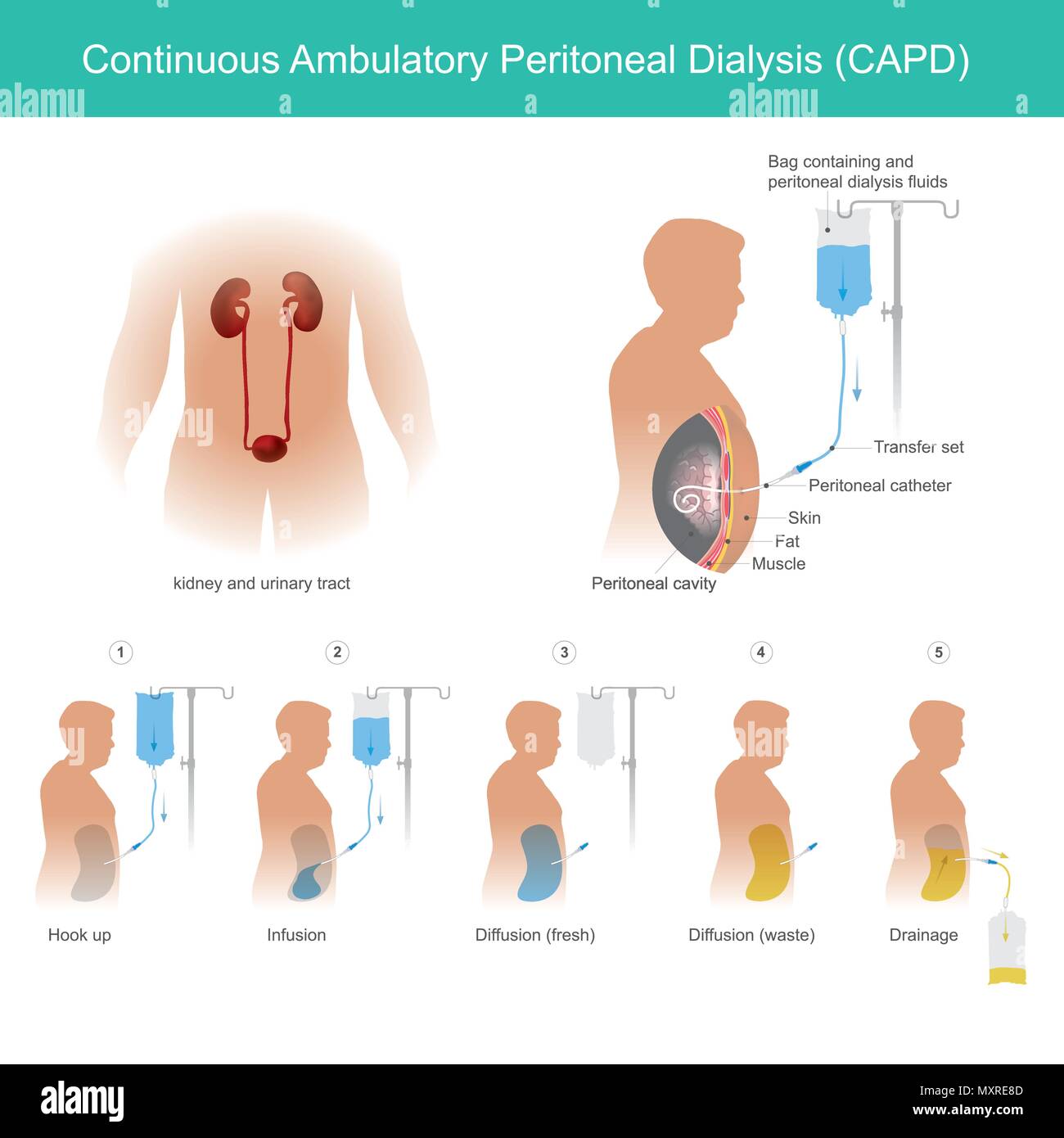 This is technical uses peritoneal cavity to transport dialysis fluid for Permeability a capillaries blood in a peritoneal cavity. Stock Vector