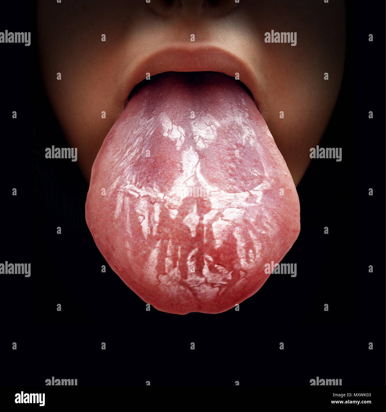 Tongue disease or oral thrush and candidiasis infectious disease of the inner mouth as the fungal illness shaped as a death skull as a medical. Stock Photo