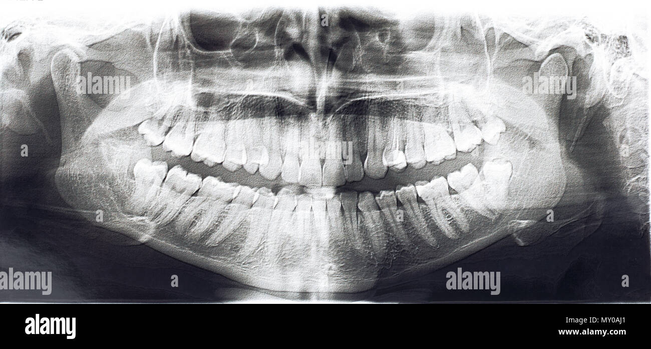 Panoramic x ray hires stock photography and images Alamy