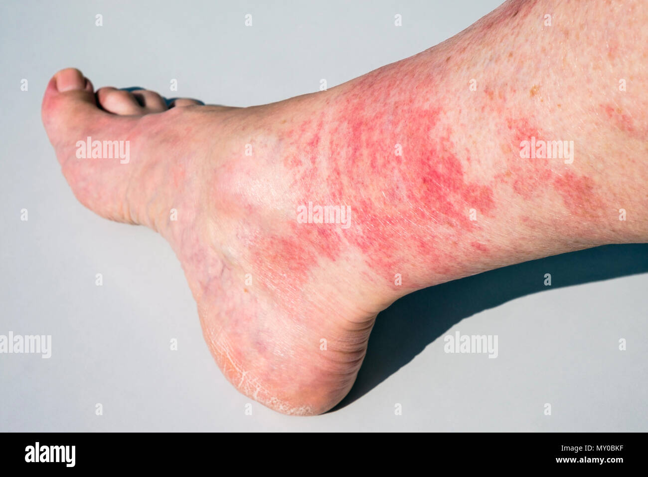 A mature woman's ankle and lower leg with prickly heat rash or golfer’s vasculitis causing red skin due to getting too hot when walking or exercising Stock Photo