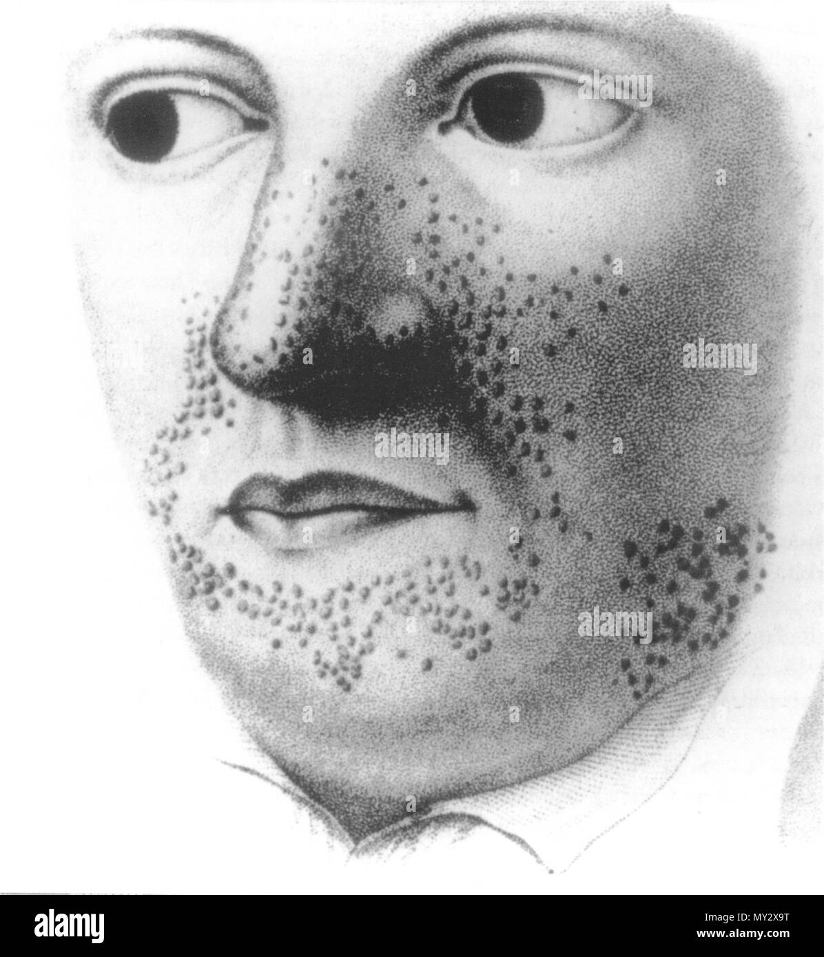 English: The earliest illustration of tuberous sclerosis, with clusters of  facial angiofibromas, displayed in Rayer's colour atlas of skin diseases  published in 1835. 1835. Pierre François Olive Rayer (1793 - 1867) 537  TuberousSclerosis-Rayer Stock ...