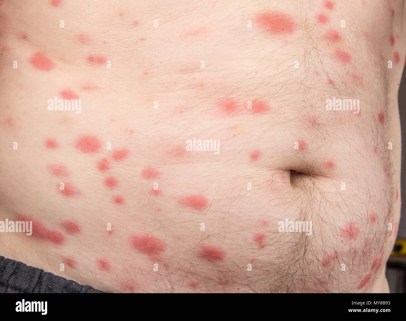 Bites Of Insect On Male Body Bed Bugs Or Flea Stock Photo Alamy