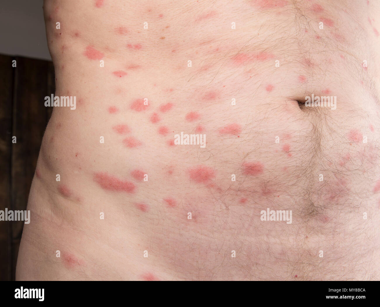 Bed Bug Bite On Skin Hi Res Stock Photography And Images Alamy