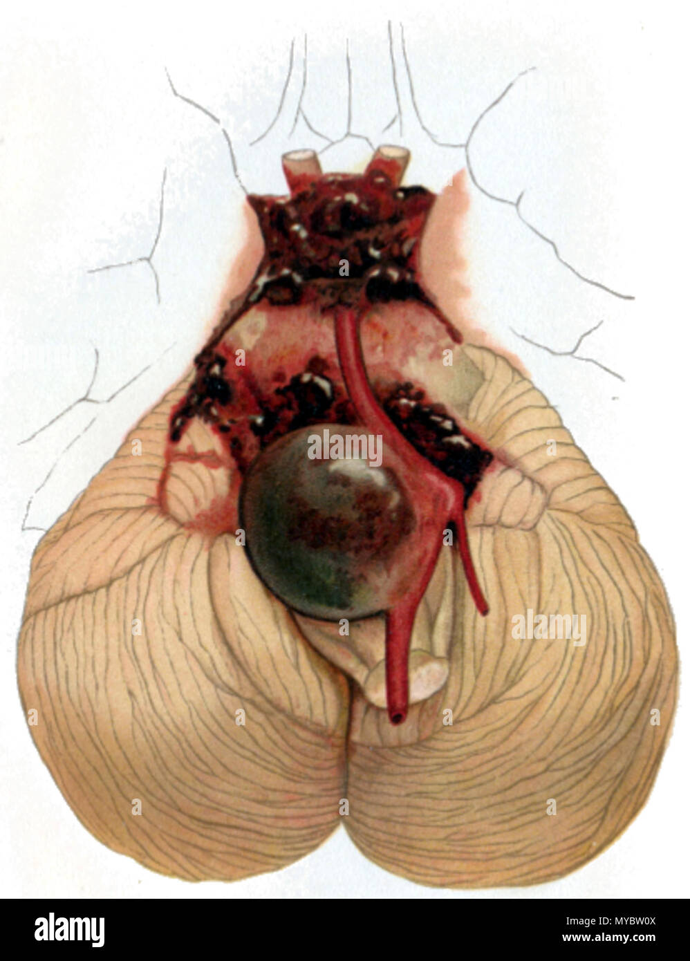 . Deutsch: Aneurysma der Arteria basilaris und der Arteriae vertebralis English: Aneurysm of the basilar artery and the vertebral arteries . 10 December 2013, 16:21:57. Professor Dr. O. Bollinger. 103 Cerebellar aneurysm Stock Photo