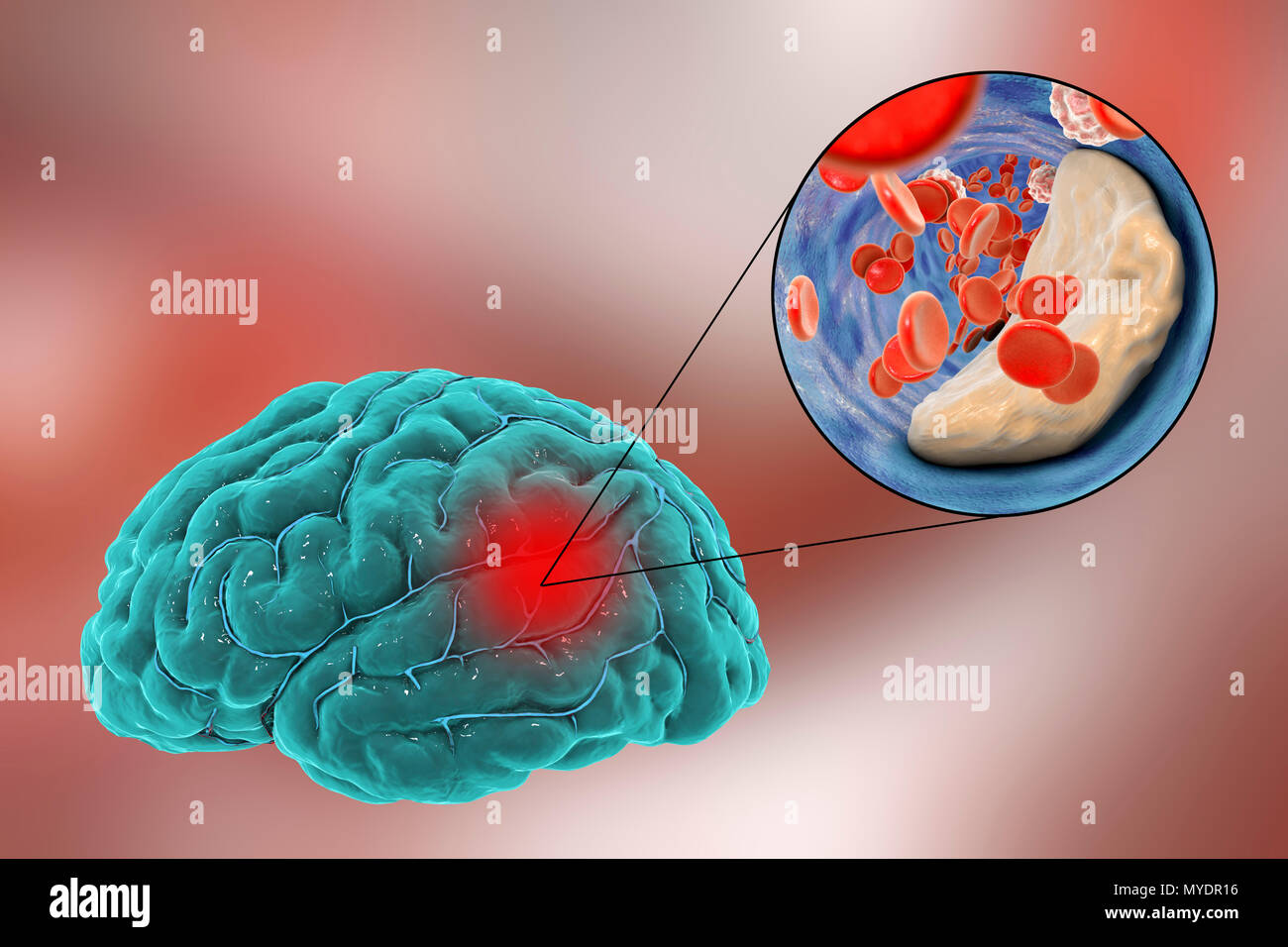 Cerebrovascular accident hires stock photography and images Alamy