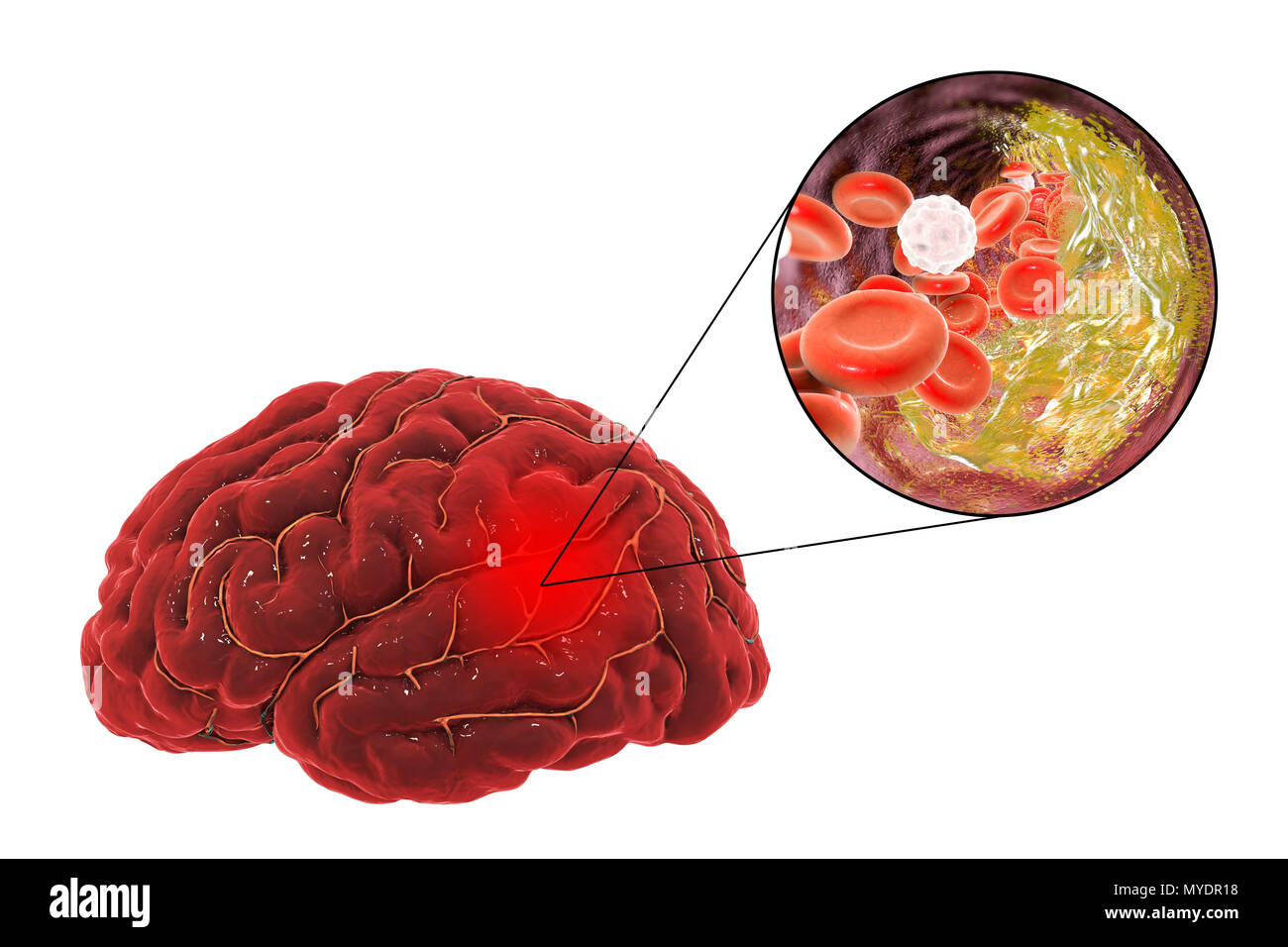 Stroke due to atherosclerosis. Illustration of an arterial blockage (expanded view at upper right) causing a stroke (cerebrovascular accident, CVA). This stroke is due to a build-up of the plaque that forms in atherosclerosis. This blockage causes an interruption (occlusion) of the oxygenated blood supply. This will cause a stroke, where the brain is damaged due to hypoxia (lack of oxygen). The grey area at upper right shows the area of the brain affected by lack of oxygen. This type of stroke is known as an atherosclerotic stroke. Common causes are high blood pressure and arterial disease. Stock Photo