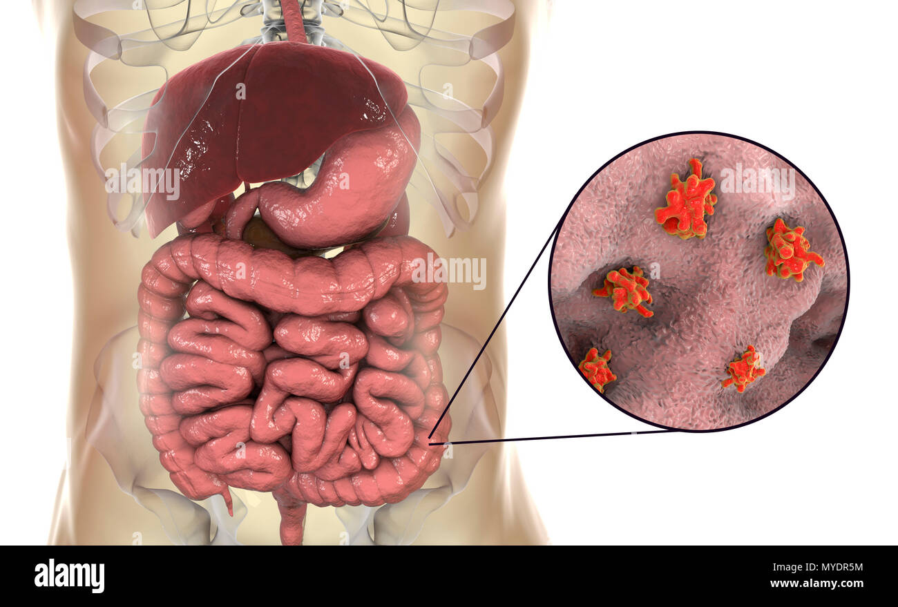 Parasitic amoeba (Entamoeba histolytica) in the large intestine, computer illustration. This single-celled organism causes amoebic dysentery and ulcers (vegetative trophozoite stage). It is spread by faecal contamination of food and water and is most common where sanitation is poor. Amoebae invade the intestine but may spread to the liver, lungs and other tissues. Infection is caused by the ingestion of cysts that develop into the pathogenic trophozoite amoeba seen here. Entamoeba histolytica occurs worldwide, with up to 50% of the population being infected, primarily in warmer climates. Stock Photo