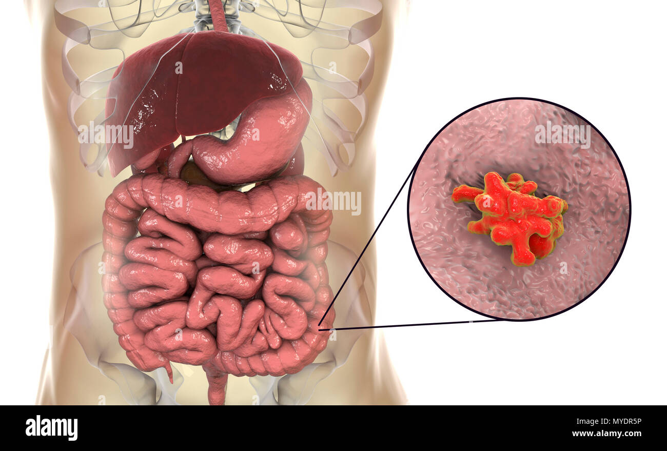 Parasitic amoeba (Entamoeba histolytica) in the large intestine, computer illustration. This single-celled organism causes amoebic dysentery and ulcers (vegetative trophozoite stage). It is spread by faecal contamination of food and water and is most common where sanitation is poor. Amoebae invade the intestine but may spread to the liver, lungs and other tissues. Infection is caused by the ingestion of cysts that develop into the pathogenic trophozoite amoeba seen here. Entamoeba histolytica occurs worldwide, with up to 50% of the population being infected, primarily in warmer climates. Stock Photo