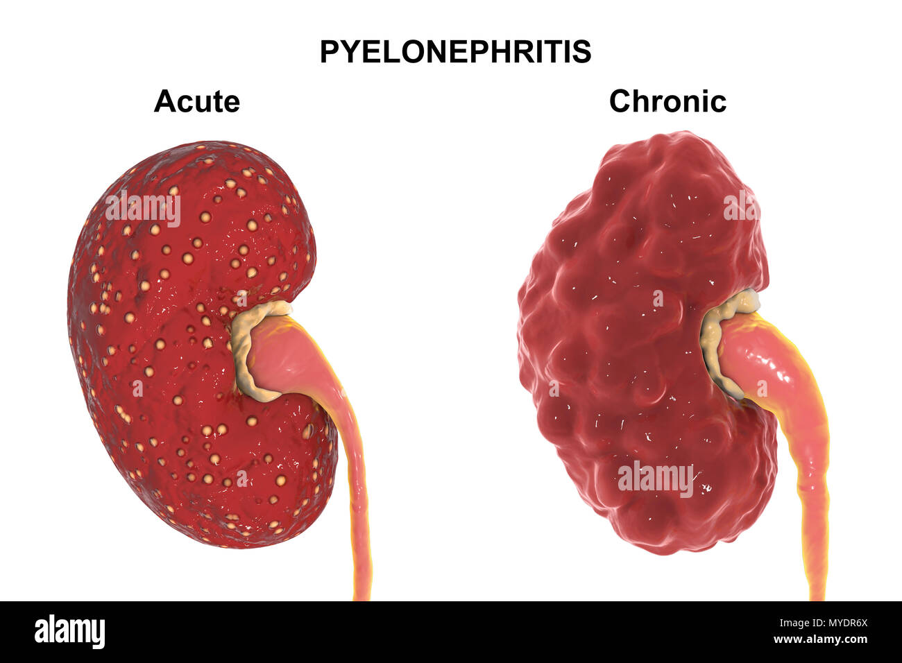 Comparison of gross anatomy of acute and chronic pyelonephritis, illustration. There are small abscesses (yellow) on the surface of the kidney with acute pyelonephritis (left). The kidney with chronic pyelonephritis (right) has an irregular scarred cortical surface, dilated and blunted calyces (yellow), and a dilated ureter. Stock Photo