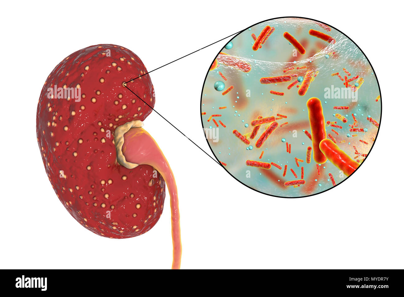 Acute pyelonephritis. Illustration of small abscesses (yellow) on the
