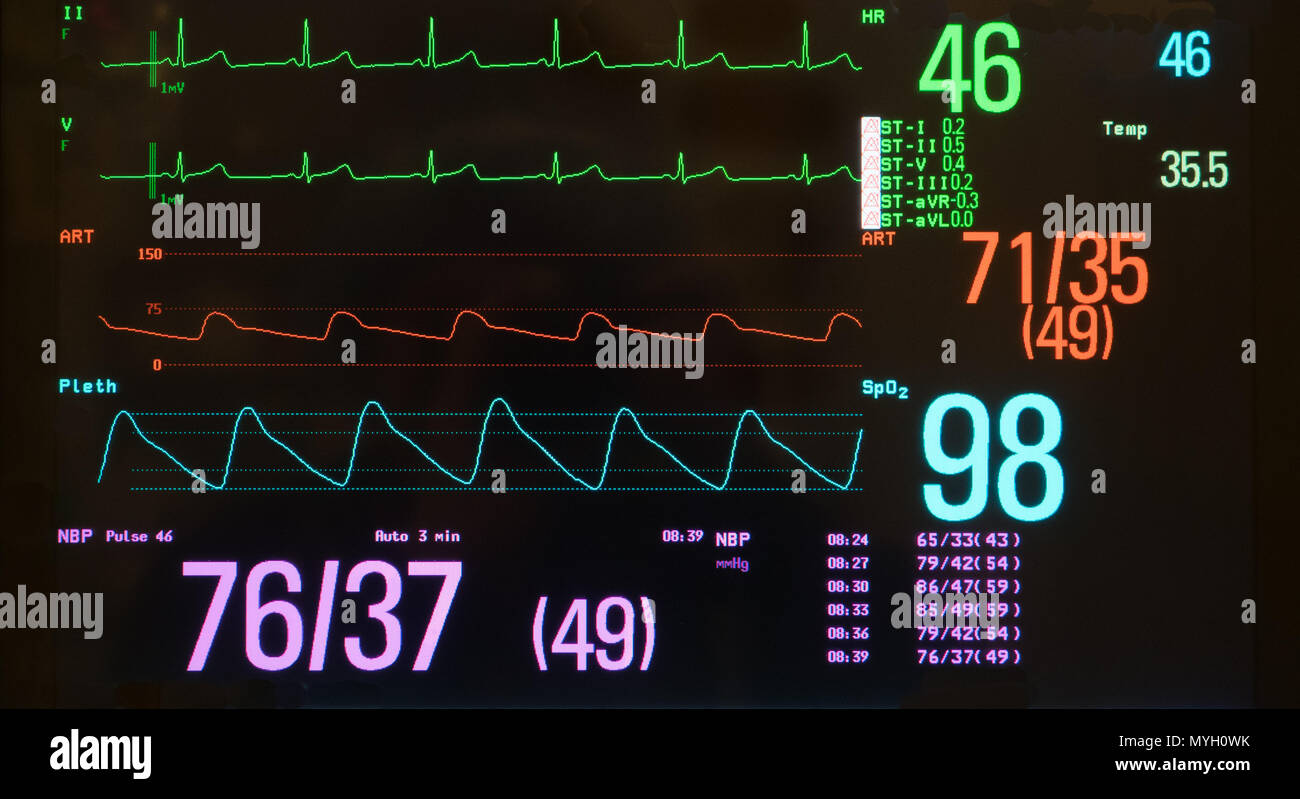 Ecg Heart Monitor