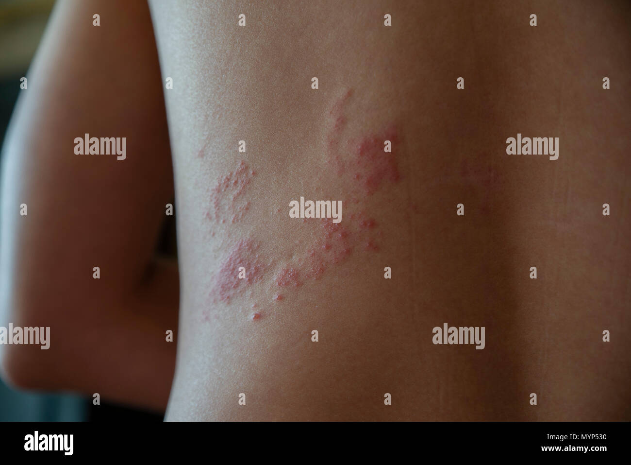 close up on zoster disease on human skin Stock Photo Alamy