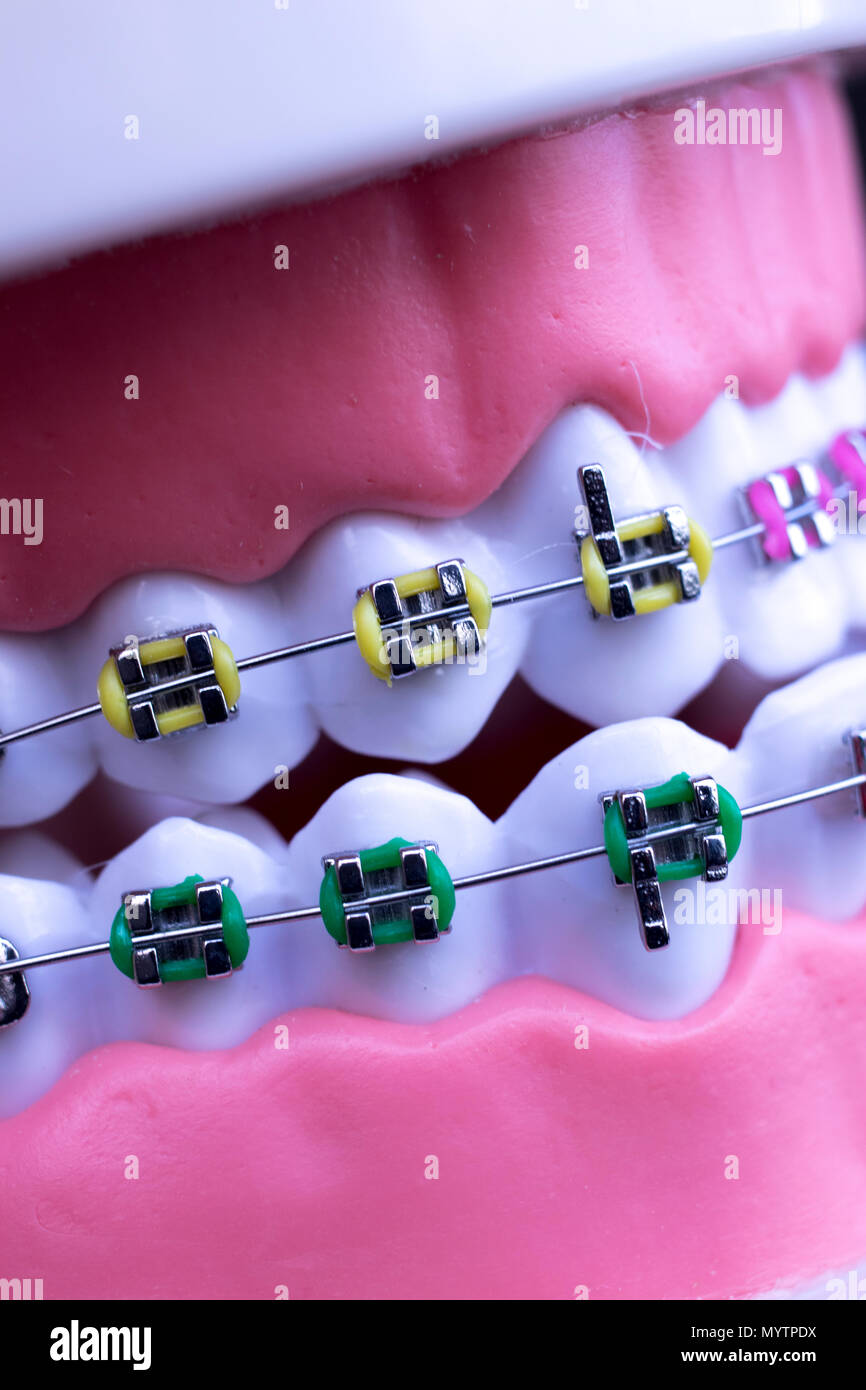Dental metal braces teeth retainer aligners teaching orthodontics model