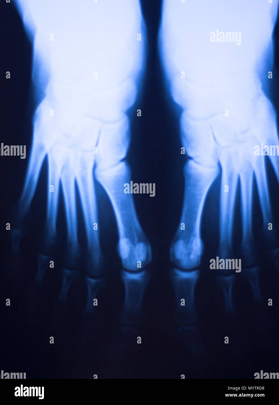 Medical Hospital X Ray Feet Traumatology Scan Stock Photo Alamy