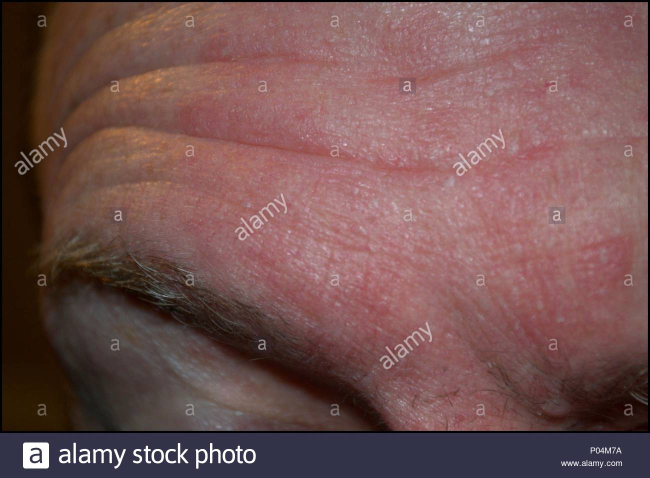 Psoriasis Scalp Stock Photos & Psoriasis Scalp Stock Images Alamy