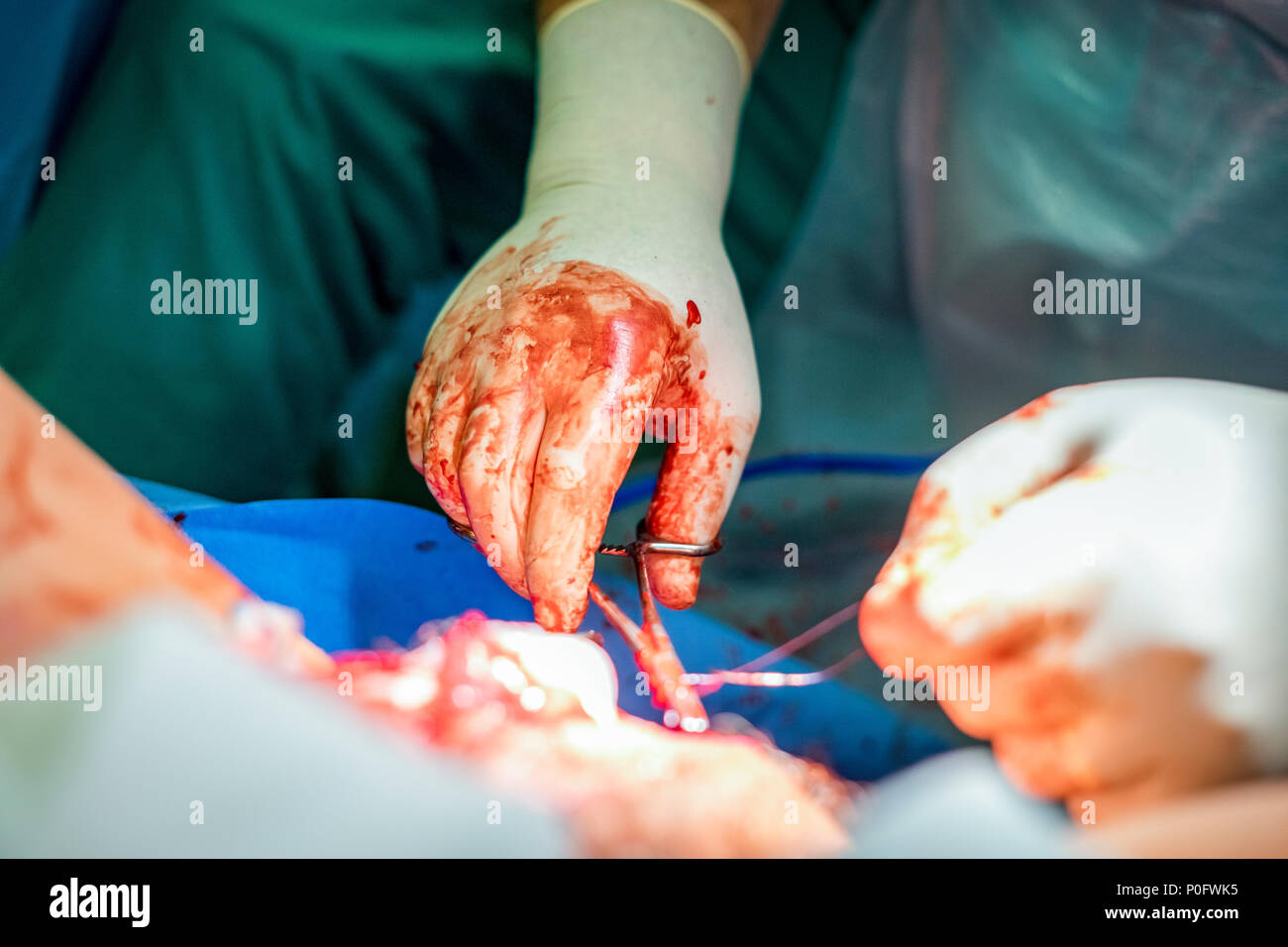 Surgeon sewing and putting stitches after operation, particularly after giving birth Stock Photo