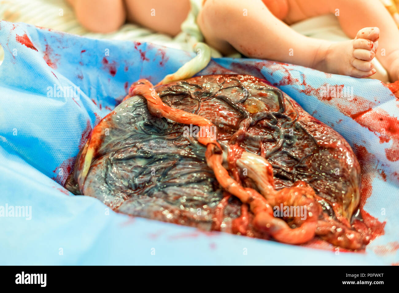 Placenta outside uterus just after childbirth and the baby in the background Stock Photo