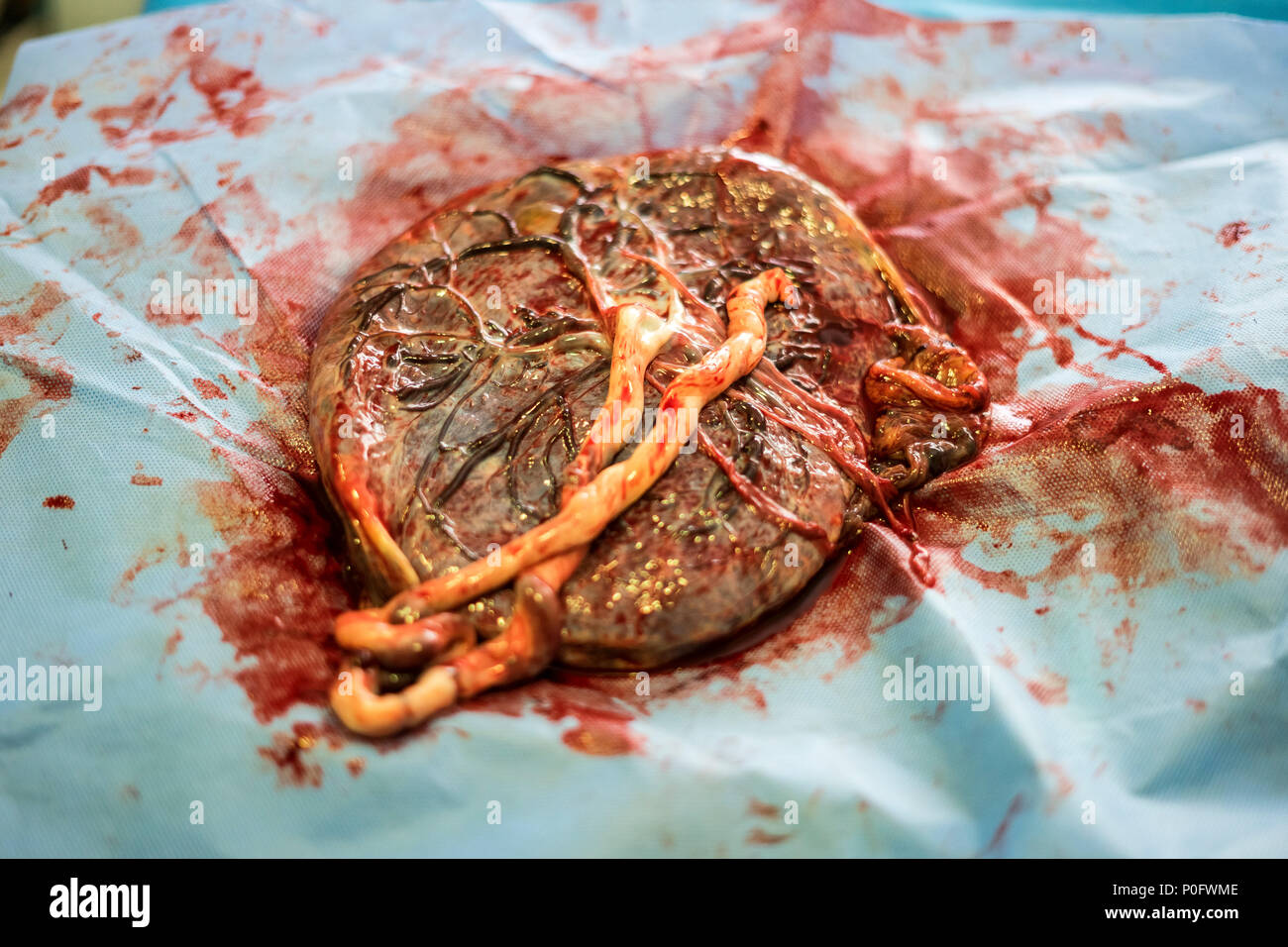 Placenta outside uterus just after childbirth in the hospital Stock Photo