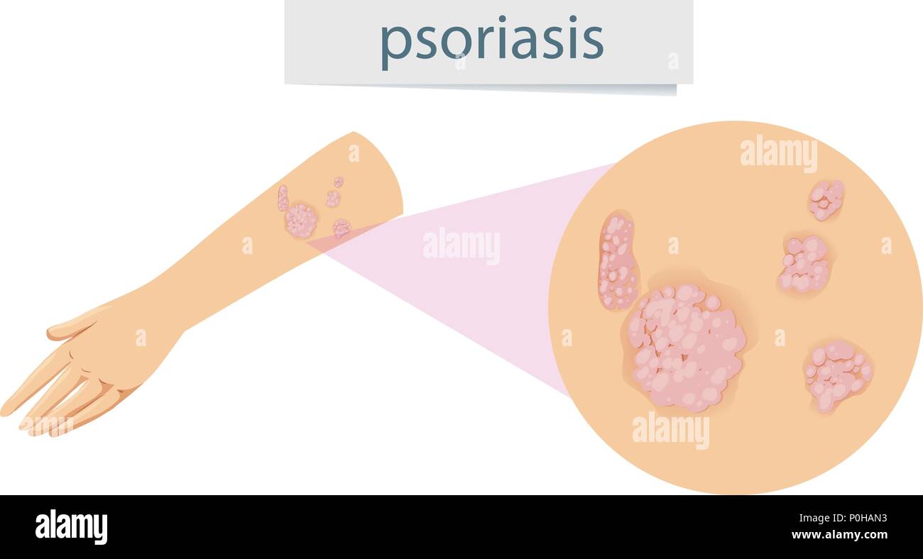 Magnified psoriasis on arm illustration Stock Vector