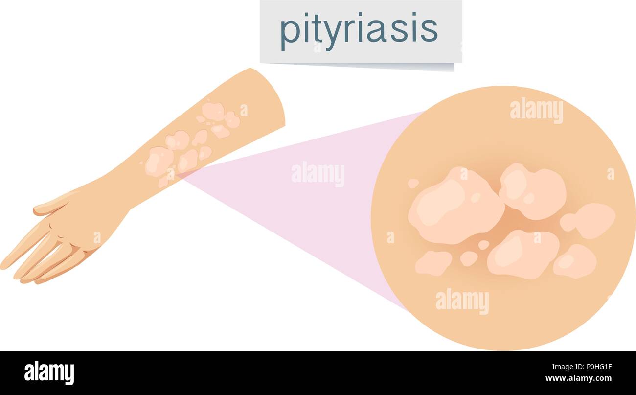 A Pityriasis on Human Skin illustration Stock Vector