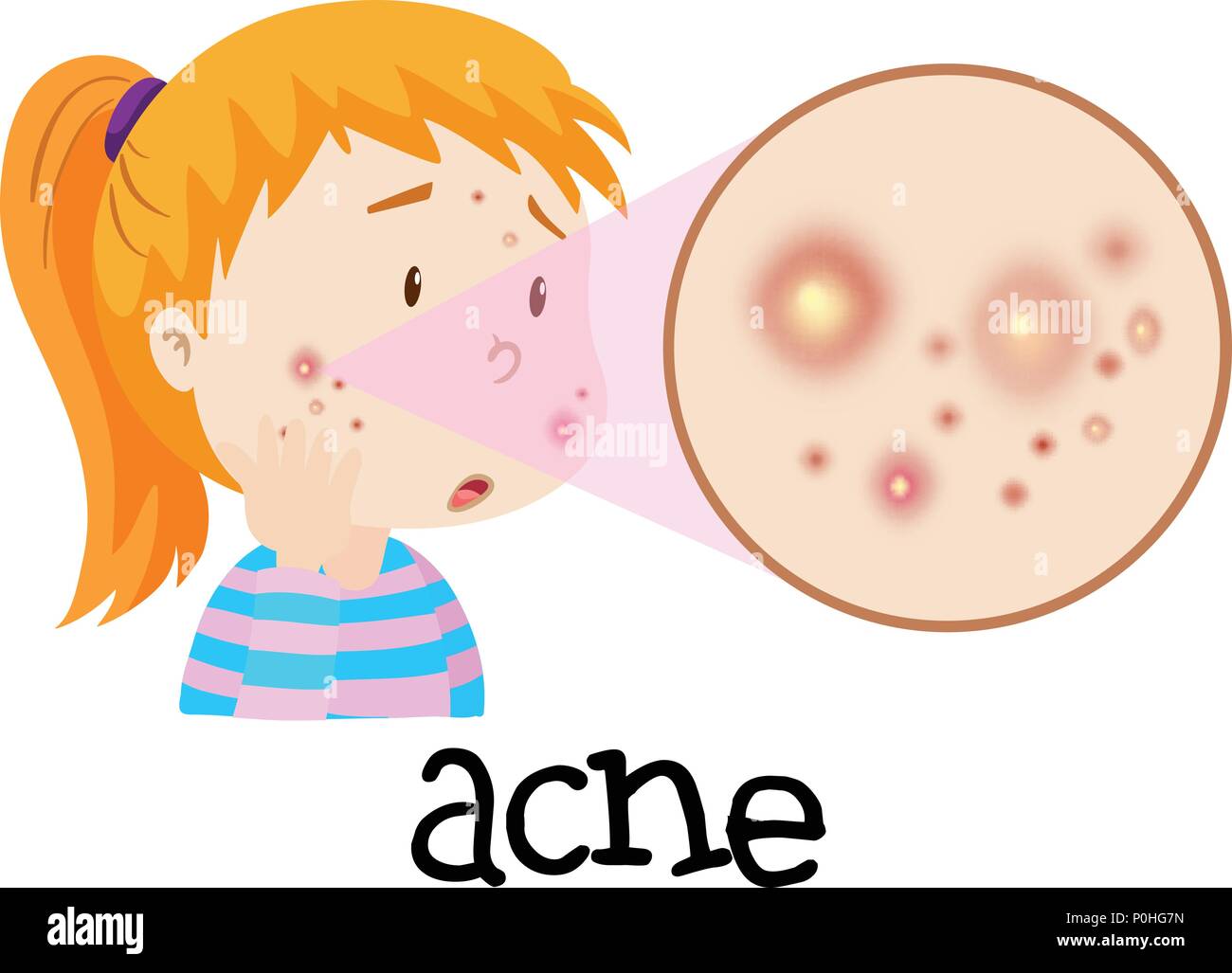 Acne Illustration High Resolution Stock Photography and Images - Alamy