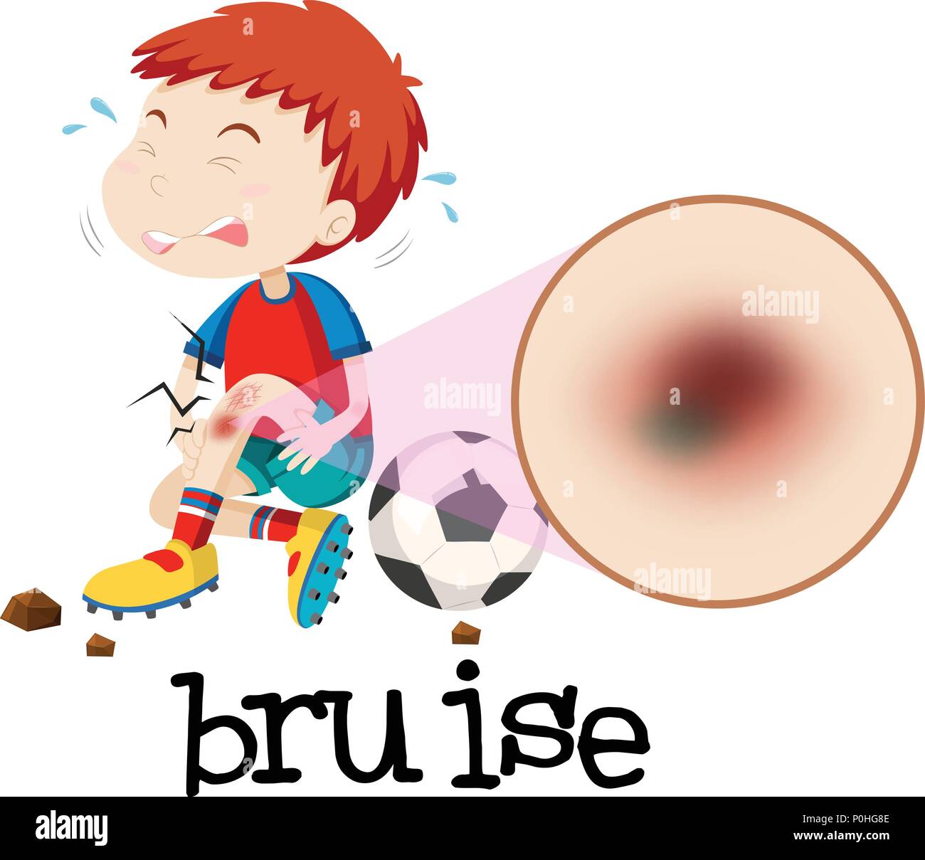 A Young Boy Habing Bruise illustration Stock Vector Image & Art Alamy