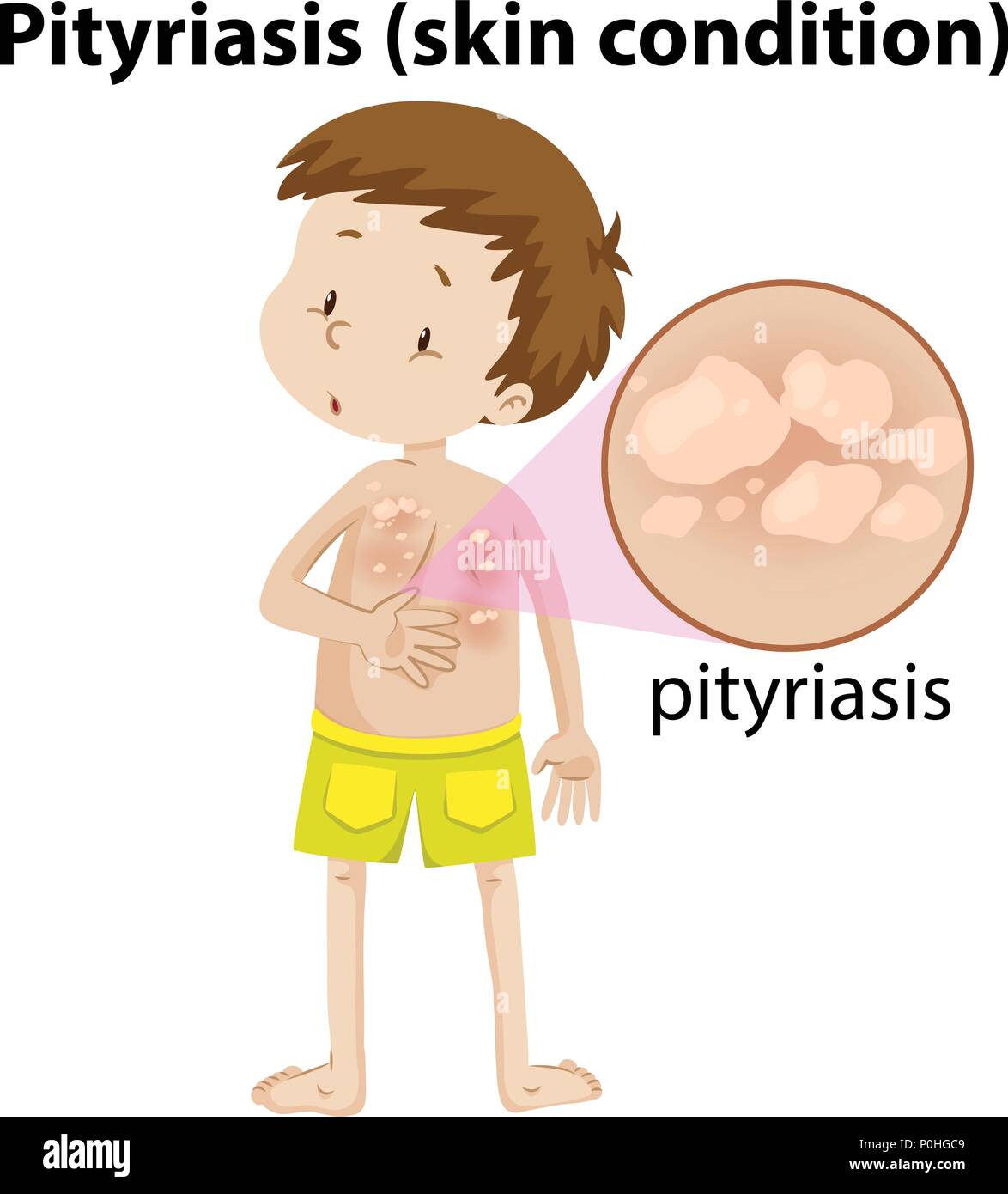 magnified pityriasis on young boy illustration Stock Vector Image & Art ...
