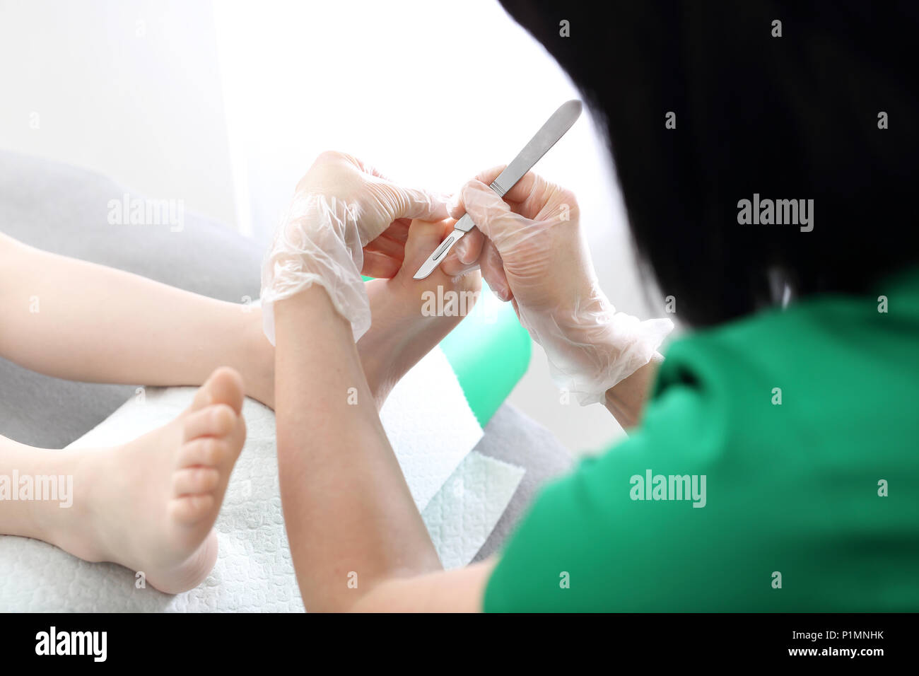 Podiatry. removing calluses with a scalpell. Stock Photo