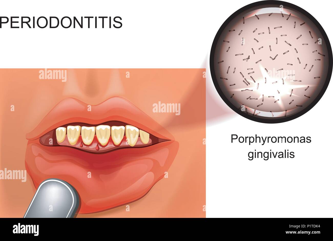 vector illustration of periodontitis. bleeding gums. stomatology Stock Vector