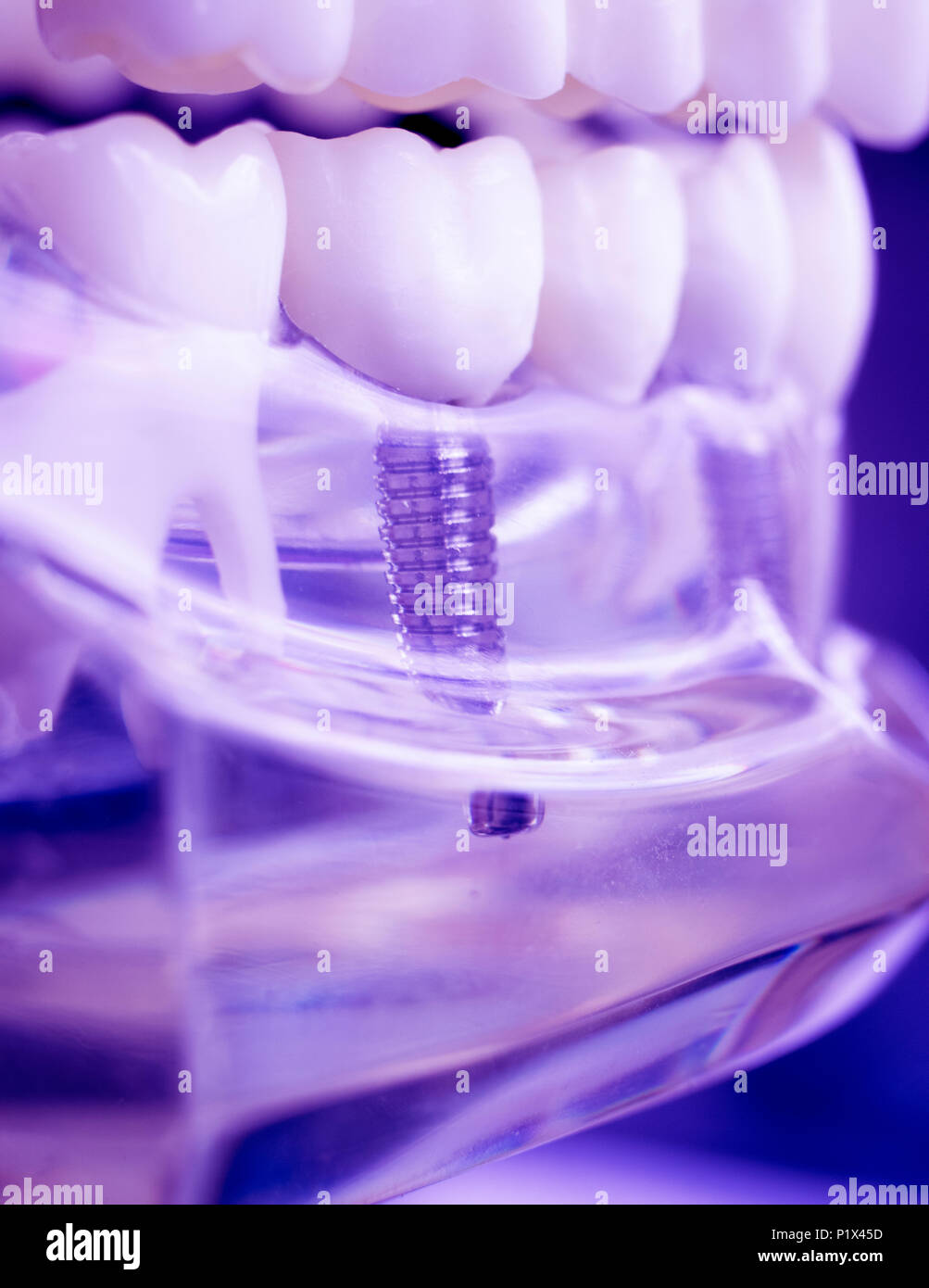 Dentist dental teeth teaching model showing titanium metal tooth